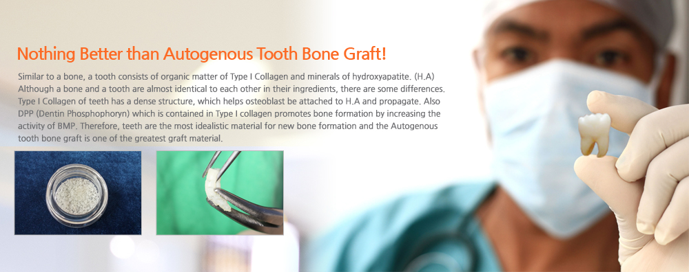 Keep your teeth!-VacuaSonic System of the patient's own teeth extractions in the office for 30 minutes, but a state-of-the-art rapid demineralized bone graft material made ​​equipment.